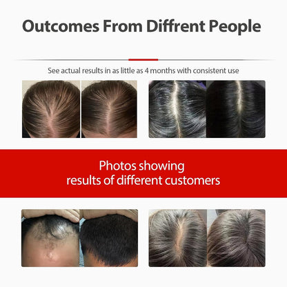 Laser Cap, Red Light Therapy for Hair Growth